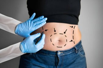 Abdominoplasty