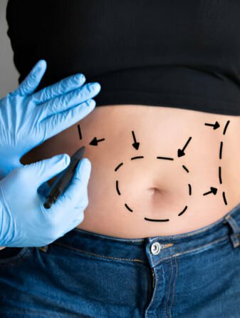 Abdominoplasty