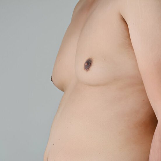 Gynecomastia