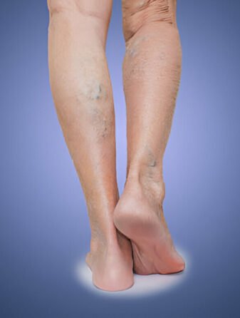 Varicose Veins