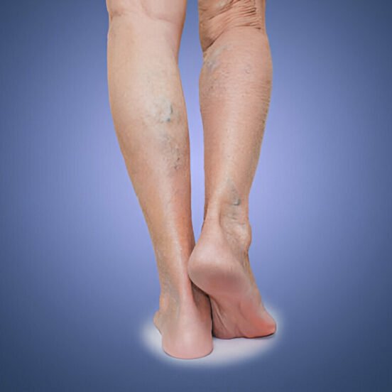 Varicose Veins